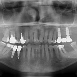 implanty stomatologiczne