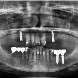 implanty stomatologiczne