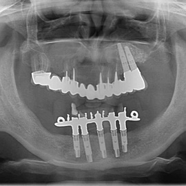 implanty stomatologiczne