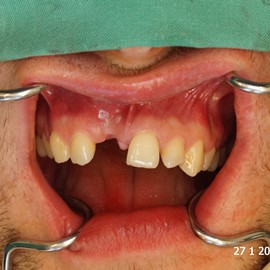 uzupełnienia zębów przednich Radom