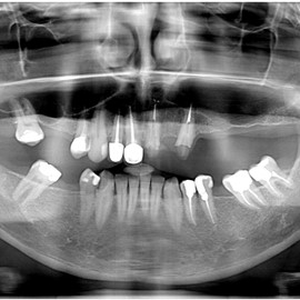 sinus lift