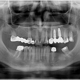 most osadzony na implantach