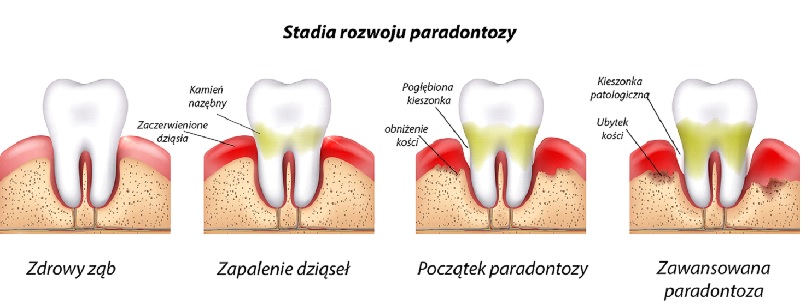 Stadia rozwoju paradontozy