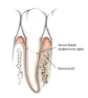 Pionowe ubytki kości wyrostka zębodołowego wokół zębów
